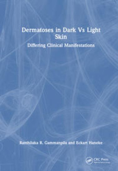 Dermatoses in Dark Vs Light Skin