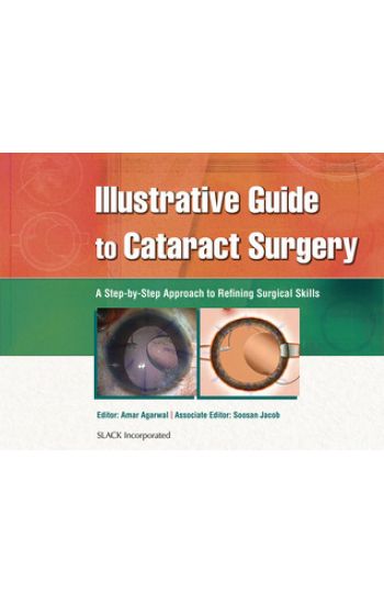 Illustrative Guide to Cataract Surgery