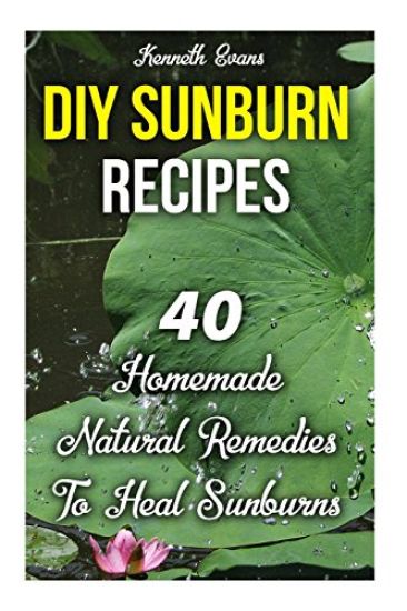 DIY Sunburn Recipes: 40 Homemade Natural Remedies To Heal Sunburns
