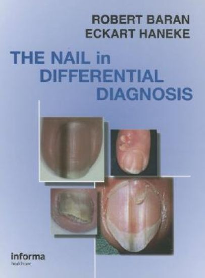 Nail in Differential Diagnosis