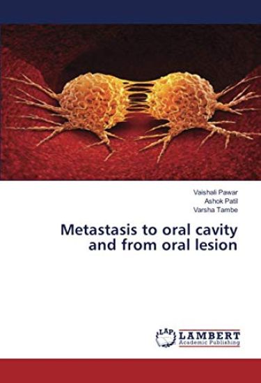Metastasis to oral cavity and from oral lesion