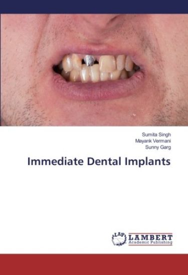 Immediate Dental Implants