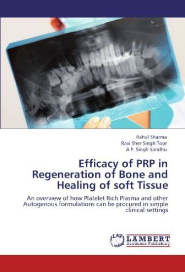 Efficacy of Prp in Regeneration of Bone and Healing of Soft Tissue