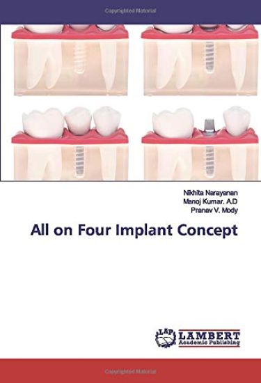 All on Four Implant Concept