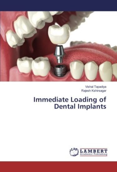 Immediate Loading of Dental Implants