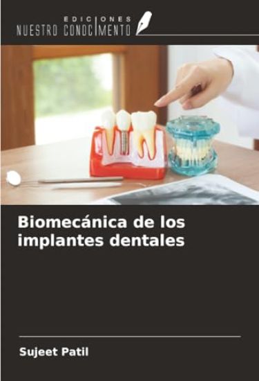 Biomecánica de los implantes dentales