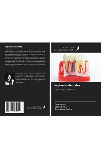 Implantes dentales