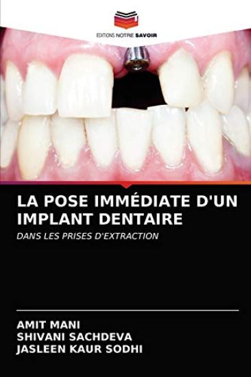 La Pose Immédiate d'Un Implant Dentaire