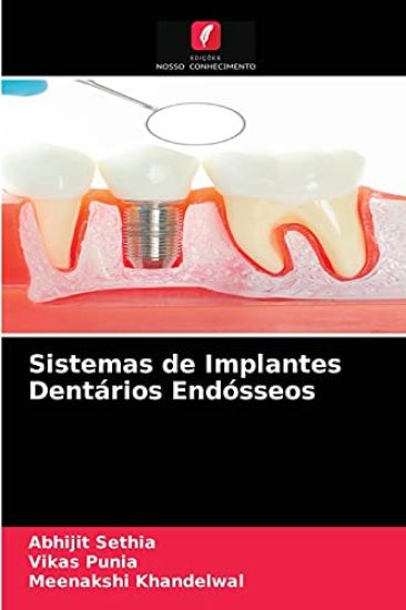 Sistemas de Implantes Dentários Endósseos