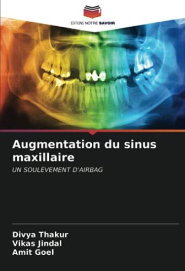 Augmentation du sinus maxillaire