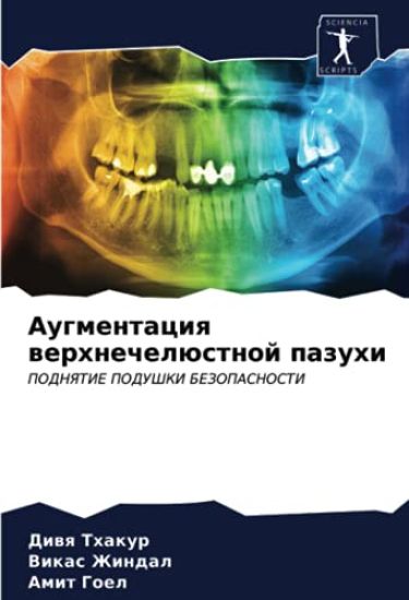 Augmentaciq werhnechelüstnoj pazuhi