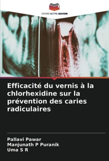 Efficacité du vernis à la chlorhexidine sur la prévention des caries radiculaires