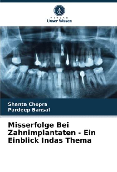 Misserfolge Bei Zahnimplantaten - Ein Einblick Indas Thema