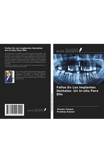 Fallos En Los Implantes Dentales- Un In-situ Para Ello