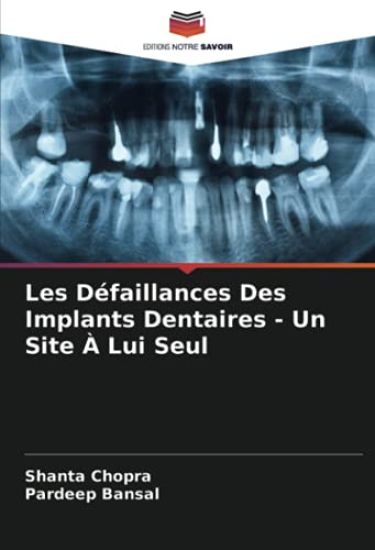 Les Défaillances Des Implants Dentaires - Un Site À Lui Seul