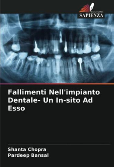Fallimenti Nell'impianto Dentale- Un In-sito Ad Esso