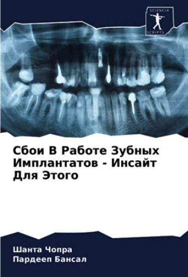 Sboi V Rabote Zubnyh Implantatow - Insajt Dlq Jetogo