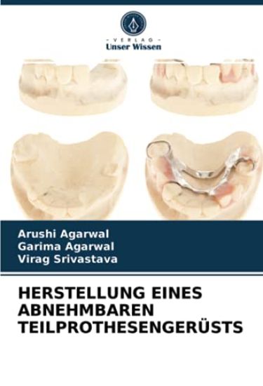 HERSTELLUNG EINES ABNEHMBAREN TEILPROTHESENGERÜSTS