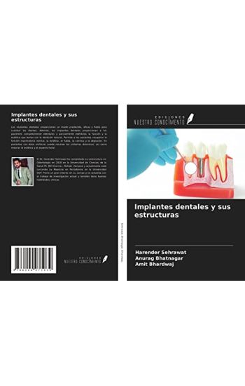 Implantes dentales y sus estructuras