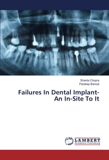 Failures In Dental Implant- An In-Site To It