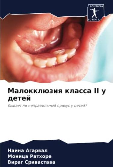 Malokklüziq klassa II u detej