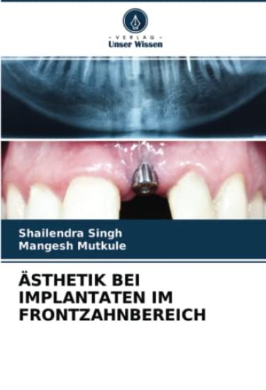 ÄSTHETIK BEI IMPLANTATEN IM FRONTZAHNBEREICH
