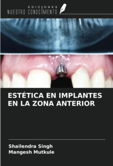 ESTÉTICA EN IMPLANTES EN LA ZONA ANTERIOR