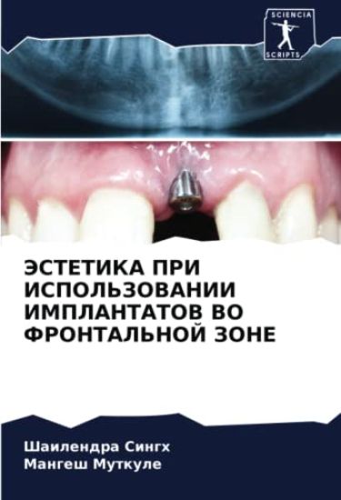 JeSTETIKA PRI ISPOL'ZOVANII IMPLANTATOV VO FRONTAL'NOJ ZONE