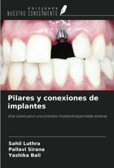 Pilares y conexiones de implantes