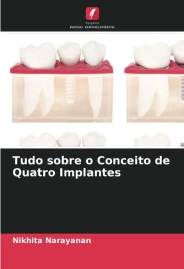 Tudo sobre o Conceito de Quatro Implantes