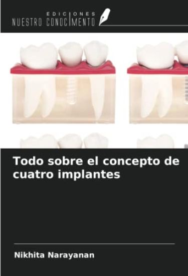 Todo sobre el concepto de cuatro implantes
