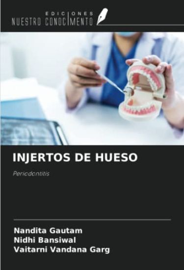 INJERTOS DE HUESO
