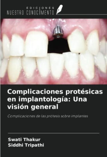Complicaciones protésicas en implantología: Una visión general