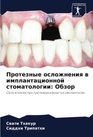 Proteznye oslozhneniq w implantacionnoj stomatologii: Obzor