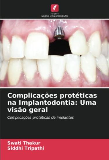 Complicações protéticas na Implantodontia: Uma visão geral