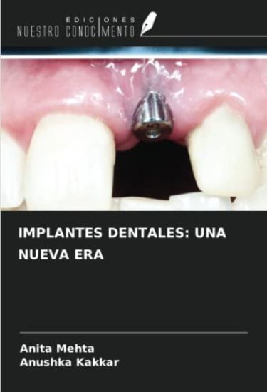 IMPLANTES DENTALES: UNA NUEVA ERA