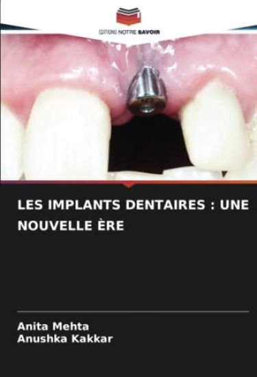 LES IMPLANTS DENTAIRES : UNE NOUVELLE ÈRE