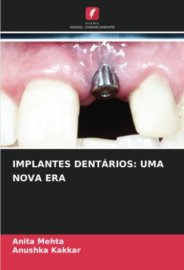 IMPLANTES DENTÁRIOS: UMA NOVA ERA