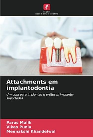 Attachments em implantodontia