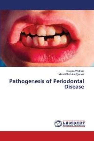 Pathogenesis of Periodontal Disease