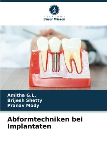 Abformtechniken bei Implantaten