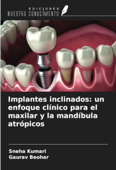 Implantes inclinados: un enfoque clínico para el maxilar y la mandíbula atrópicos