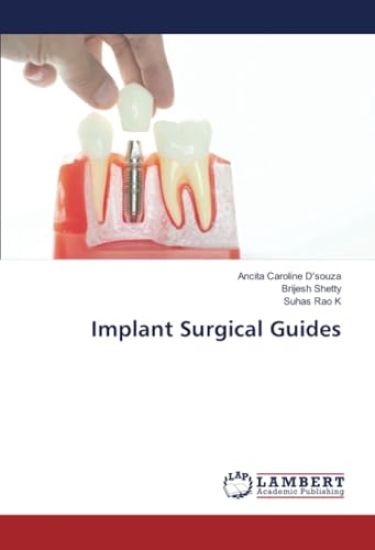 Implant Surgical Guides