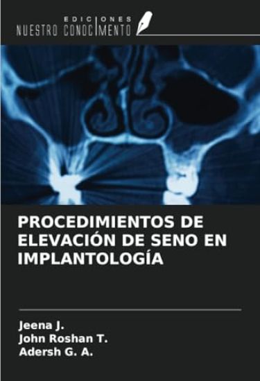 PROCEDIMIENTOS DE ELEVACIÓN DE SENO EN IMPLANTOLOGÍA