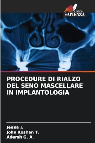 Procedure Di Rialzo del Seno Mascellare in Implantologia