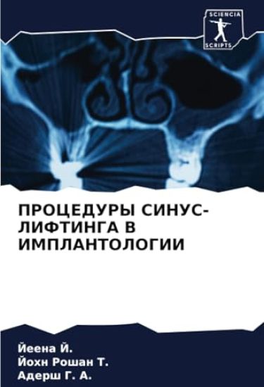 PROCEDURY SINUS-LIFTINGA V IMPLANTOLOGII