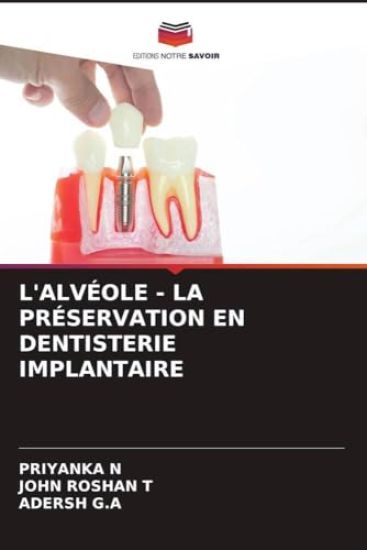 L'Alvéole - La Préservation En Dentisterie Implantaire
