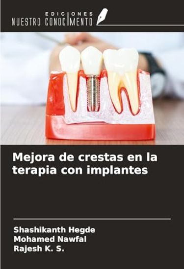 Mejora de crestas en la terapia con implantes