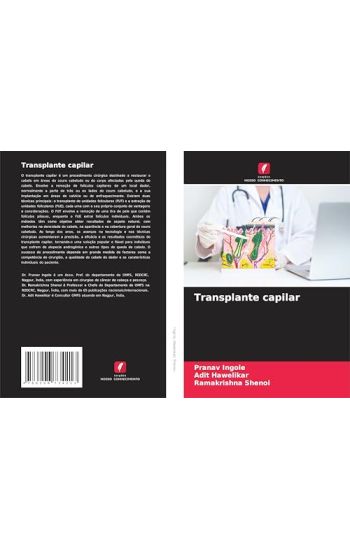 Transplante capilar