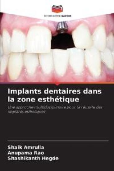 Implants dentaires dans la zone esthétique